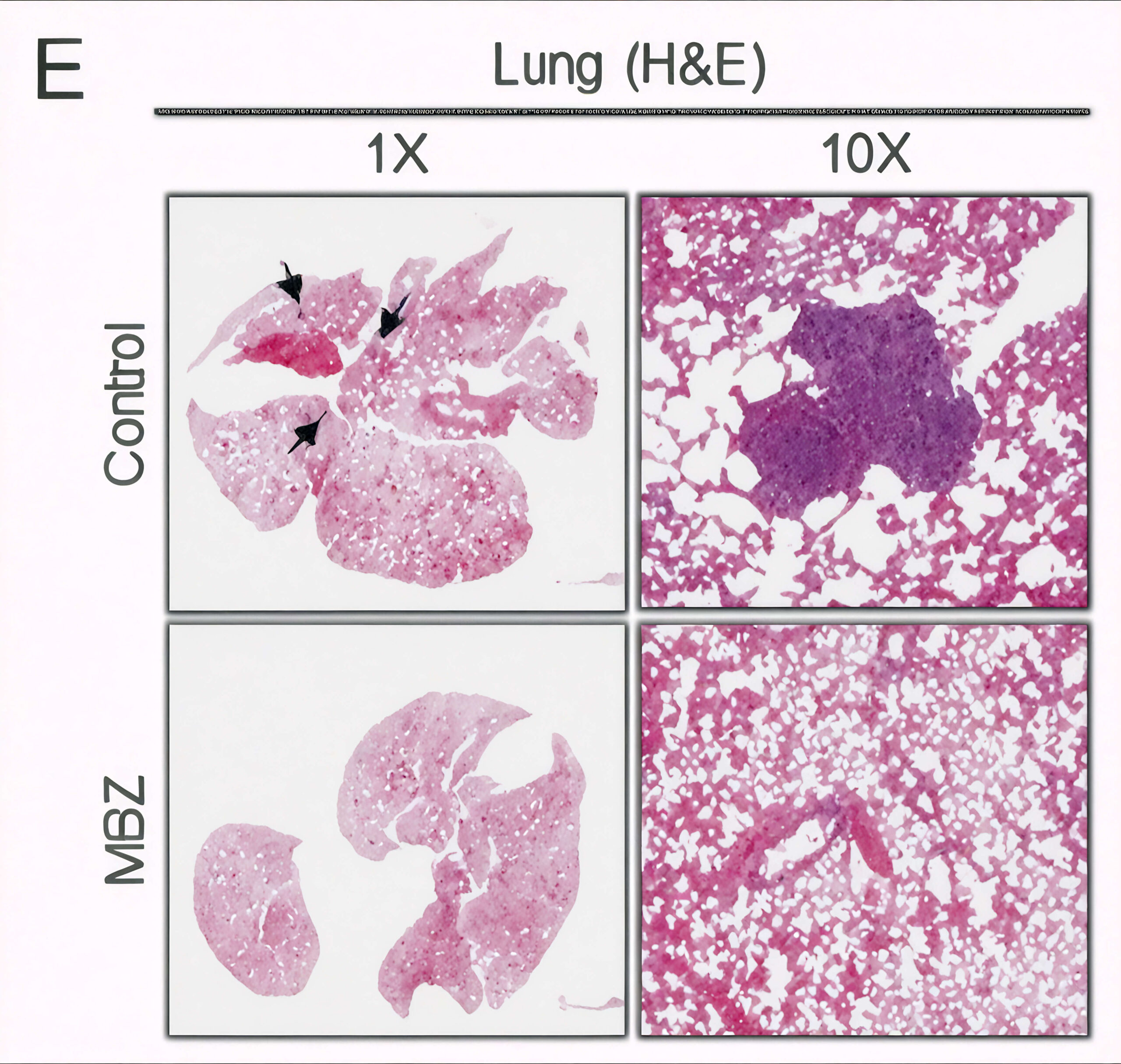 histological evaluation of pulmonary metastatic lesions